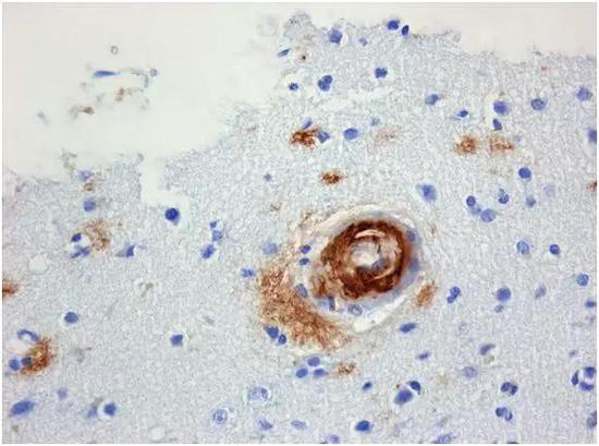 切片中β样淀粉蛋白。图片来源：meddic.jp